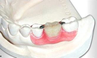 隐形义齿视频,视频带你领略口腔修复新篇章